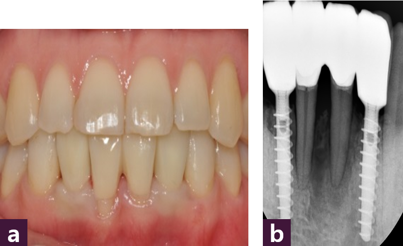 [그림 12] 최종 보철물 장착  ⓐ 구강 내 사진, ⓑ 치근단 x-ray