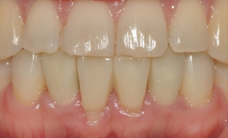 [그림 13] 최종 보철물 체결 2개월 후 구강 내 사진