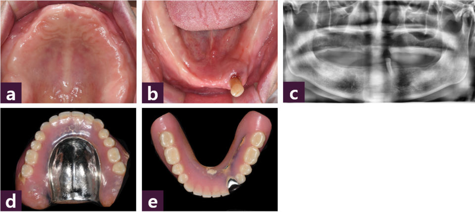 [그림 1] 초진 시 사진ⓐ 상악, ⓑ 하악, ⓒ 파노라마, ⓓ 기존 상악 의치, ⓔ 기존 하악 의치