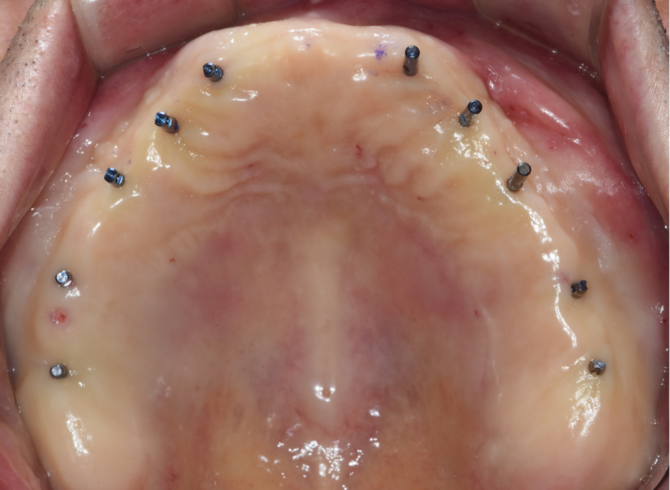 [그림 2] Magic Guide Pin을 위치시킨 모습