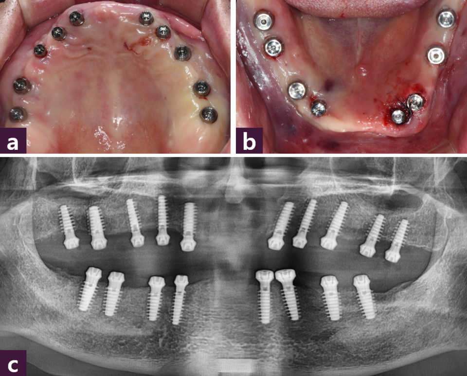 [그림 4] 수술 직 후 사진 ⓐ 상악, ⓑ 하악, ⓒ 파노라마