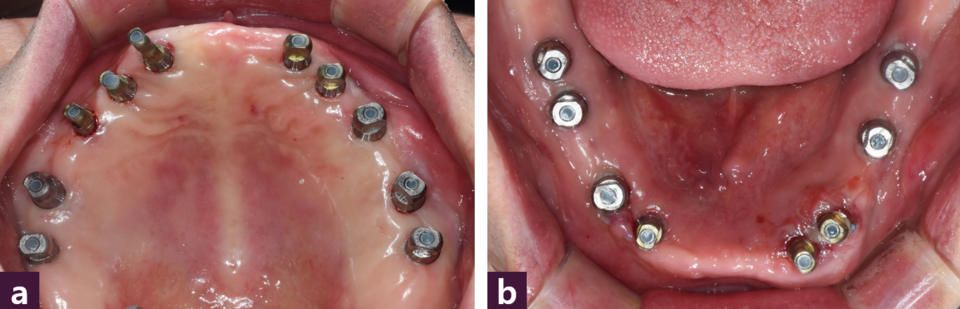 [그림 5] Impression coping 체결 ⓐ 상악, ⓑ 하악