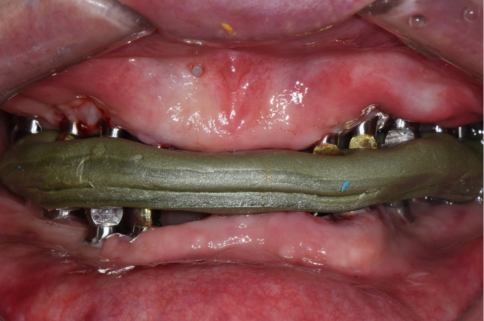 [그림 6] 악간 관계 채득