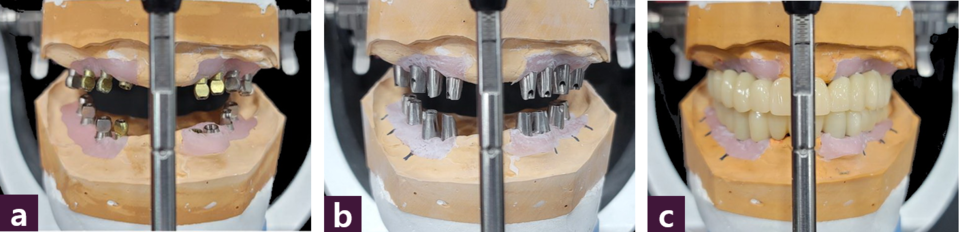 [그림 7] PMMA 치아 제작 과정  ⓐ 교합기 마운팅, ⓑ 제작된 맞춤 지대주, ⓒ 제작된 PMMA 임시치아