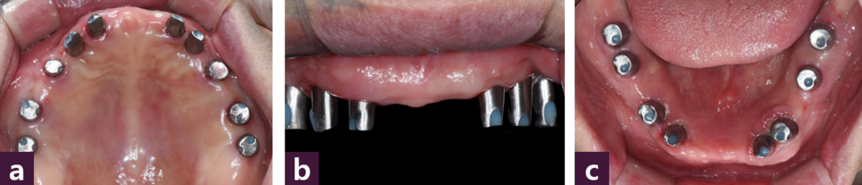 [그림 8] 구강 내 장착된 customized abutment  ⓐ 상악 교합면, ⓑ 상악 순측면, ⓒ 하악 교합면