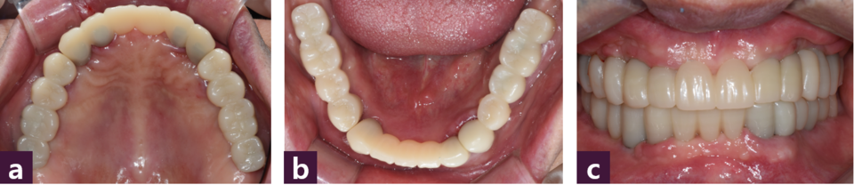 [그림 9] 수술 8일 후 구강 내 장착된 PMMA 치아  ⓐ 상악, ⓑ 하악, ⓒ 순측면