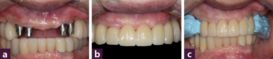 [그림 10] 최종 보철물 제작을 위한 악간 관계 채득ⓐ 부분적 임시 보철물 제거, ⓑ 제작된 상악 전치 zirconia보철물, ⓒ 교차 마운팅을 위한 바이트 채득