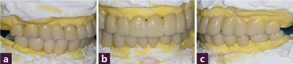 [그림 11] 최종 보철물의 교합 조정  ⓐ 우측, ⓑ 순측, ⓒ 좌측
