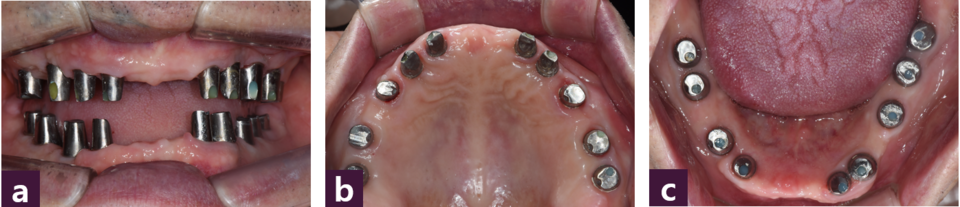 [그림 12] 최종 보철물을 위한 맞춤형 지대주  ⓐ 전면, ⓑ 상악, ⓒ 하악