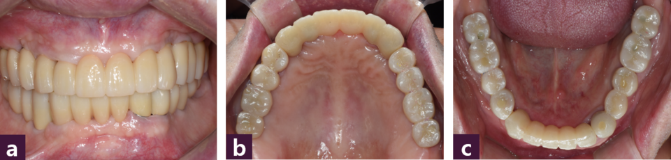 [그림 13] 최종 지르코니아 보철물을 장착한 구강 내 사진  ⓐ 전면, ⓑ 상악, ⓒ 하악