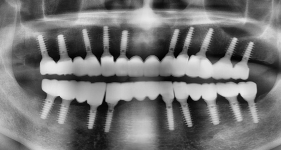 [그림 14] 최종 보철 후 파노라마