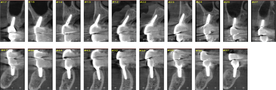 [그림 15] 최종 보철 후 CBCT section view