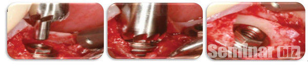 네오바이오텍의 ‘Bone profile’