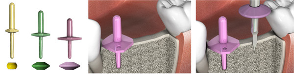 Multiple Case에서 ‘MD Parallel Pin’, ‘MD Spacer’