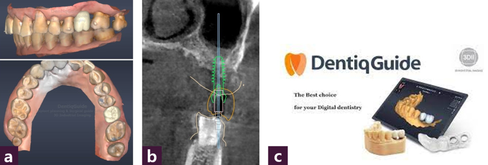 [그림 2] CAD 자료   ⓐ Crown design, ⓑ fixture axis, ⓒ Dentiq Guide