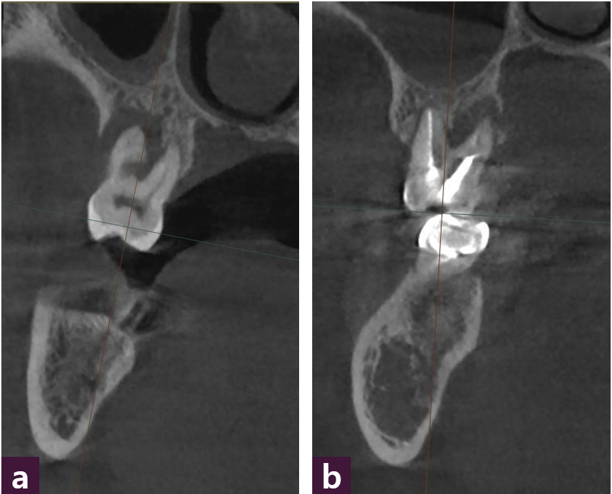 [그림 3] 결손 형태에 따른 분류  ⓐ Buccal lost pattern, ⓑ lingual lost pattern