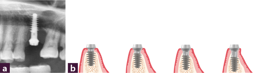 [그림 4] Magic Cuff의 활용  ⓐ 긴 Magic Cuff를 식립한 파노라마, ⓑ 상황에 따른 Magic Cuff의 활용 모식도