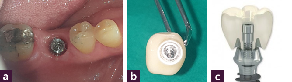 [그림 5] Magic Crown  ⓐ Magic Crown 장착 전 구강내 사진, ⓑ 제작된 screw type Magic Crown,ⓒ screw type Magic Crown의 모식도