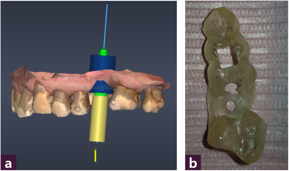 [그림 6] CAM 자료  ⓐ CAM file, ⓑ 3D printed guide