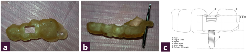 [그림 8] CAM process   ⓐ 3D printed guide, ⓑ GPS Drill inserted guide, ⓒ offset 모식도