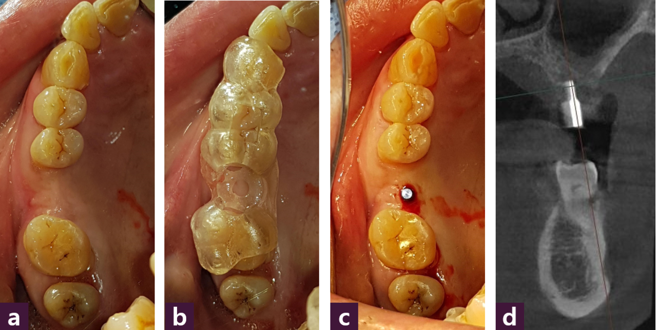 [그림 9] AMII guide implant doingⓐ 술 전, ⓑ adaptation, ⓒ GPS, ⓓ verify,