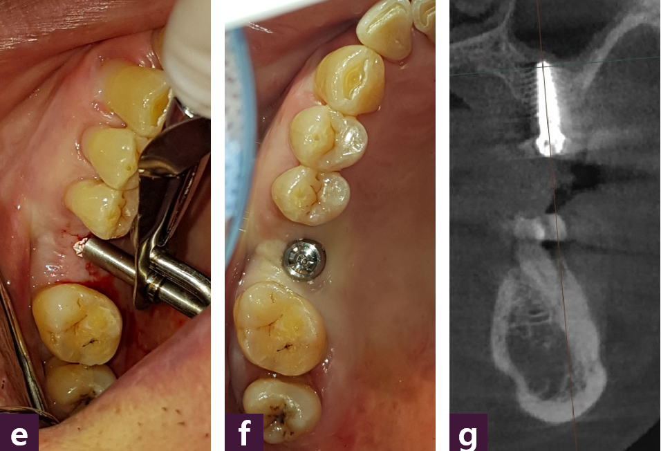 [그림 9] AMII guide implant doing ⓔ bone grafting, ⓕ MFD & MFI, ⓖ confirm