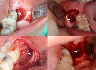 △하악 사랑니 발치 후 하치조 신경 (흰색 화살표)이 드러난 환자들.