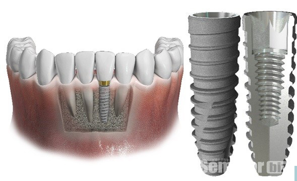 ▲ IS-III active S-narrow