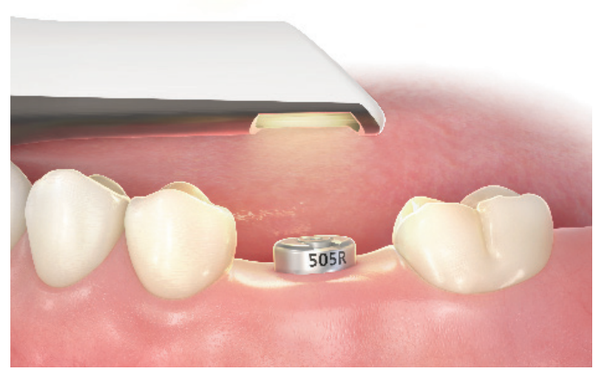 Scan Healing abutment