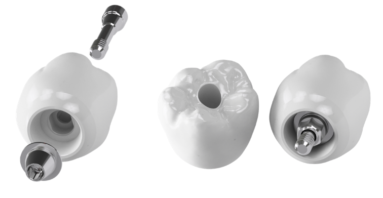 Fig. 3.Highness link와 지르코니아 크라운과의 결합