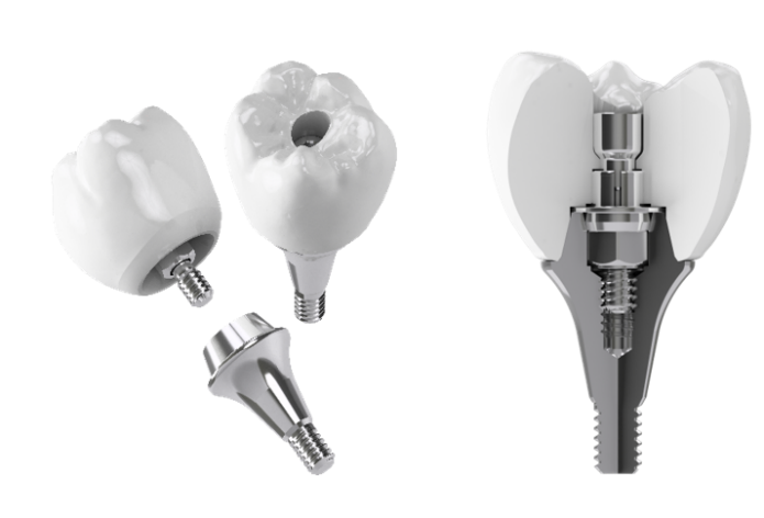 Fig. 4. Screw 유지형 지르코니아 크라운과 Highness base abutment와의 결합