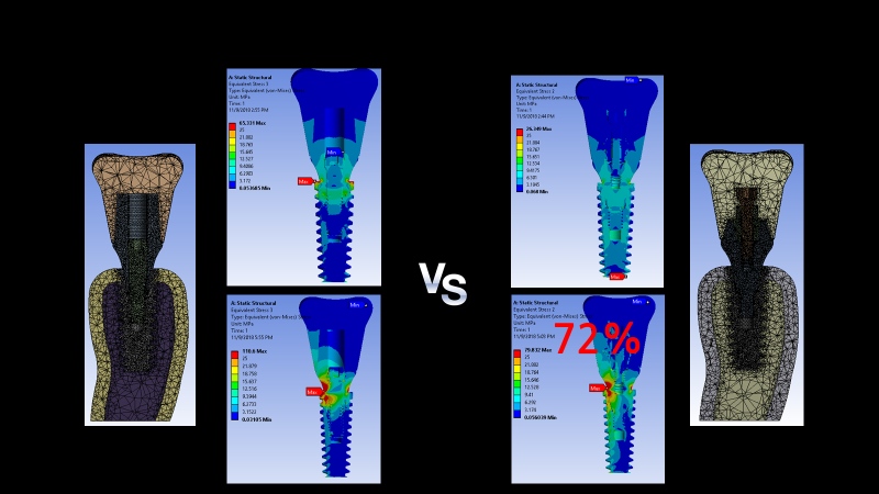 Fig. 8. 임플란트-보철 복합체의 FEA