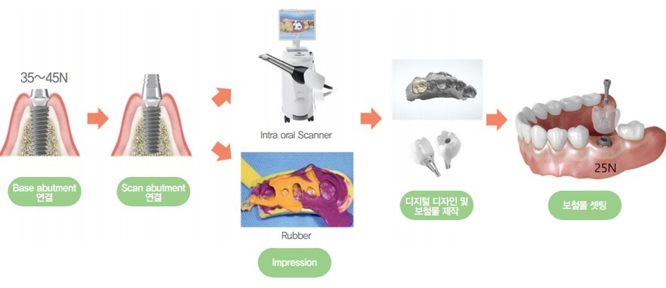 Fig.1 하이니스보철 workflow