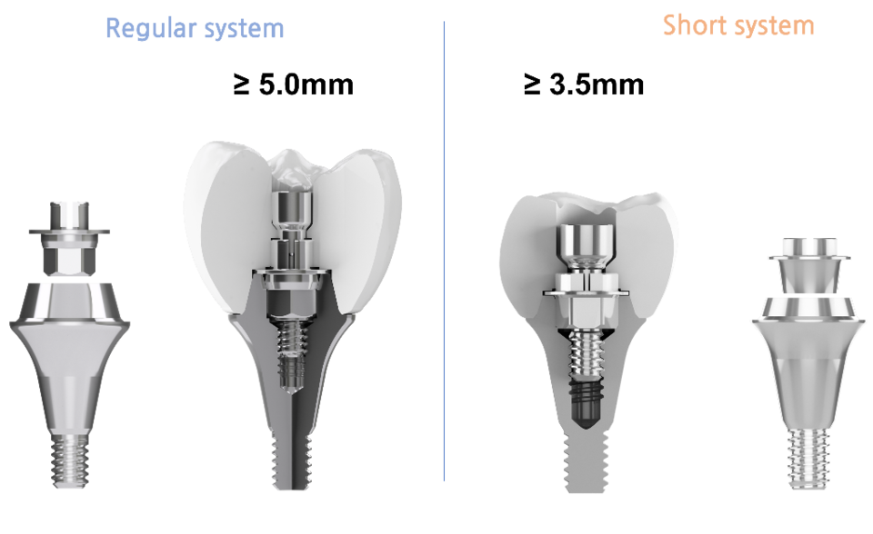 Fig. 2 Occlusal clearance