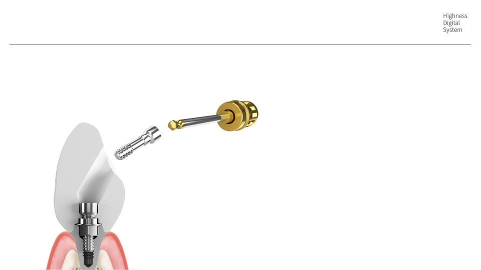 Fig.3 AngledHighnessCrown(25도 각도까지 제작 가능)