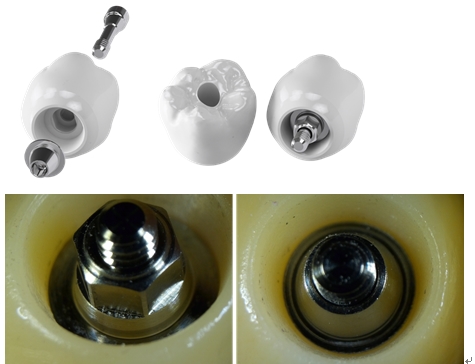 Fig.4 하이니스 임플란트 보철물제작