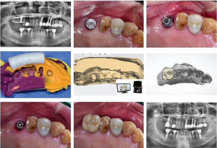 Fig.5 Single crown case