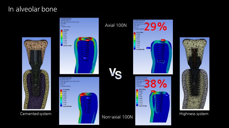 Fig. 4. Crestal marginal bone의 FEA