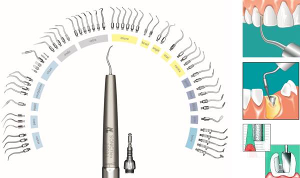 소닉 플렉스 팁 임상적용 예시