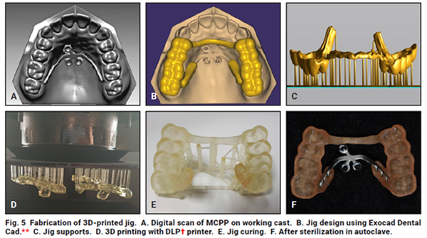 3D 프린팅(printing) 이용한 개인 맞춤형 교정장치(지그, jig) 제작 과정