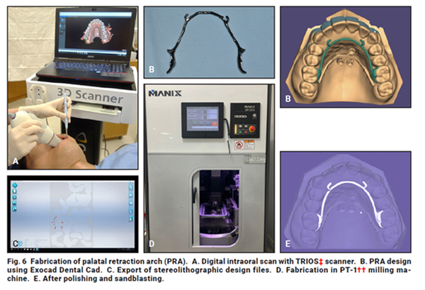 환자 구강을 디지털 스캔을 이용해 디지털 모형으로 재현하고, 개인의 구강내 모형과 가장 적합하도록 정밀성을 높여 제작한다.