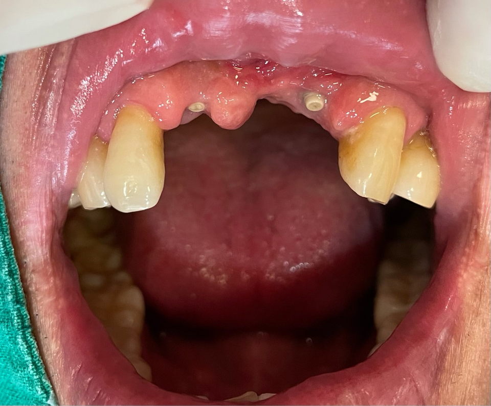 그림 1.  필자가 부르는 사과꼭지 커버스크류로 노출을 최소화했다.