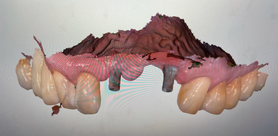 그림 2.  abutment를 스캔바디로 사용해 간편하다.