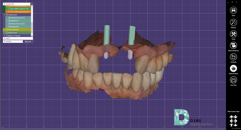 그림 3.  Exocad 디자인. 스캔바디 매칭이 정확하다.