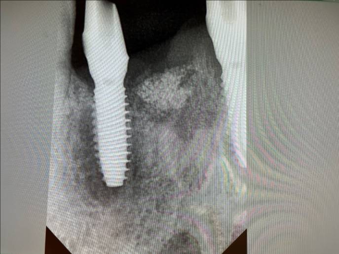 그림 4.  심플하고 강해 보이는 fixture 방사선 모습