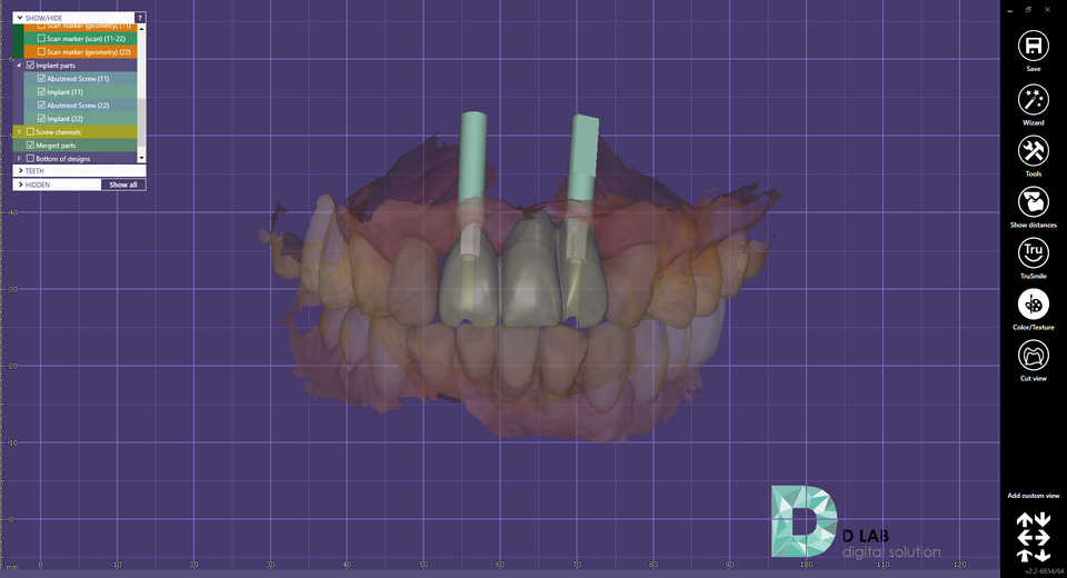 그림 5.  상부 임시치아 디자인, screw type 제작