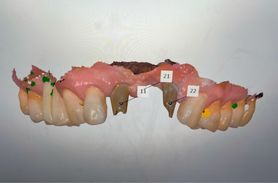 그림 6.  모델제작이 없기에 fitting을 다시 확인하기 위한 abutment 스캔