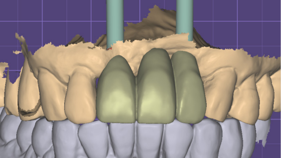 그림 7.  Final zirconia 상부 보철 디자인