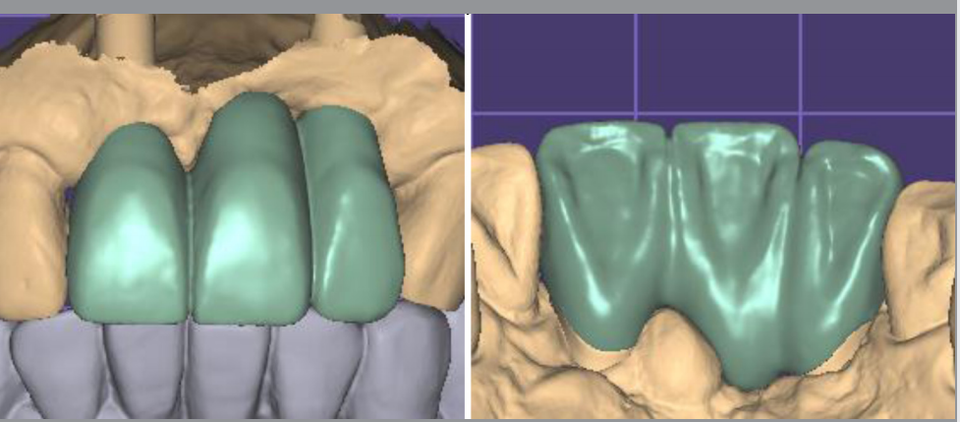 그림 8.  기공소에서 동봉하는 디자인 리포터