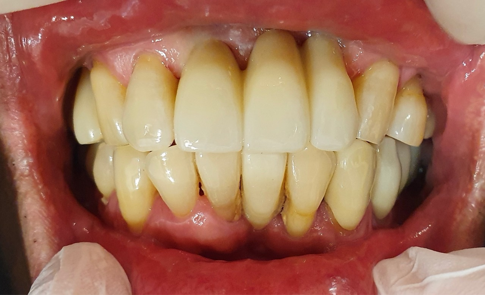 그림 9.  최종 구강 내 지르코니아 보철물 ( modeless로 전 과정 진행 )